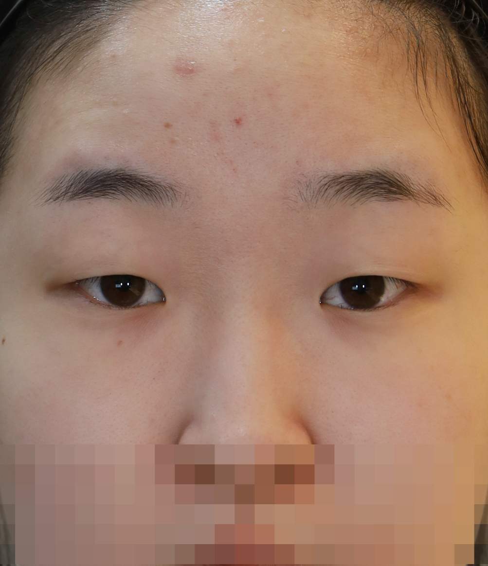 절개 쌍꺼풀, 앞 위 트임 수술전