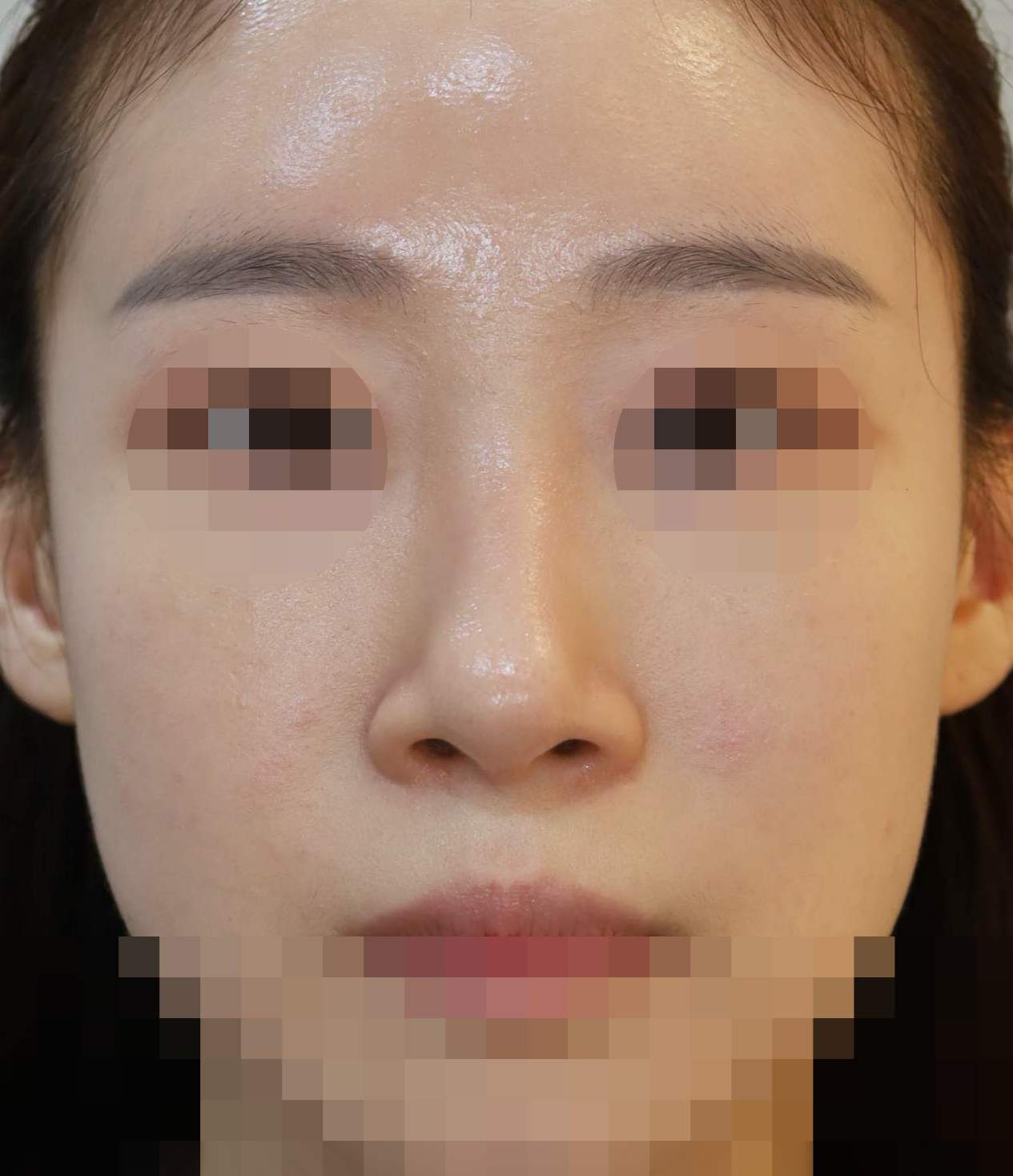 무보형물 코재수술; 들린코 교정 6개월 수술후