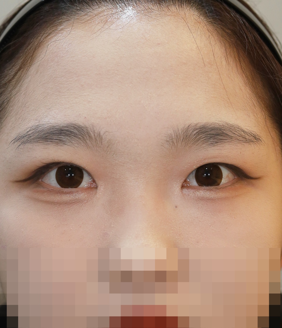 쌍꺼풀 라인 낮추기; 두줄따기, 안검하수 교정, 앞트임 6개월 수술후