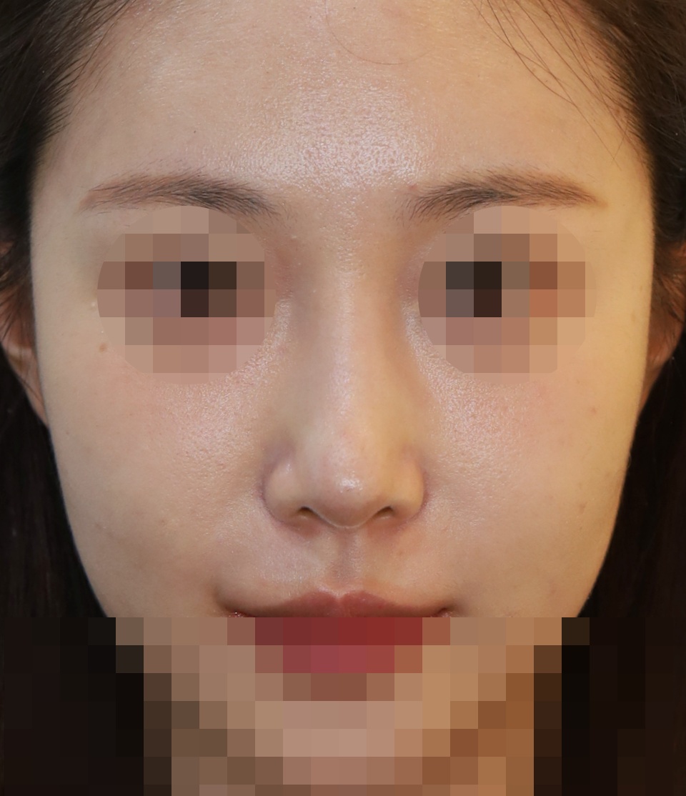 콧대(맞춤보형물), 코끝(귀연골), 비주올리기 수술후