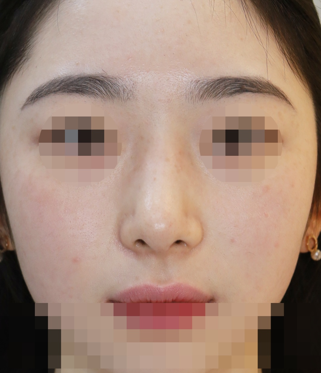 무보형물 코성형; 휜코 교정, 매부리 교정 3개월 수술후