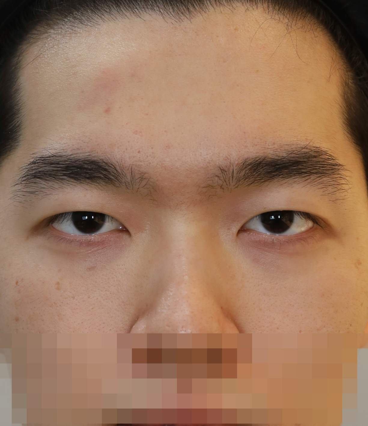 비절개 쌍꺼풀 3개월 수술후