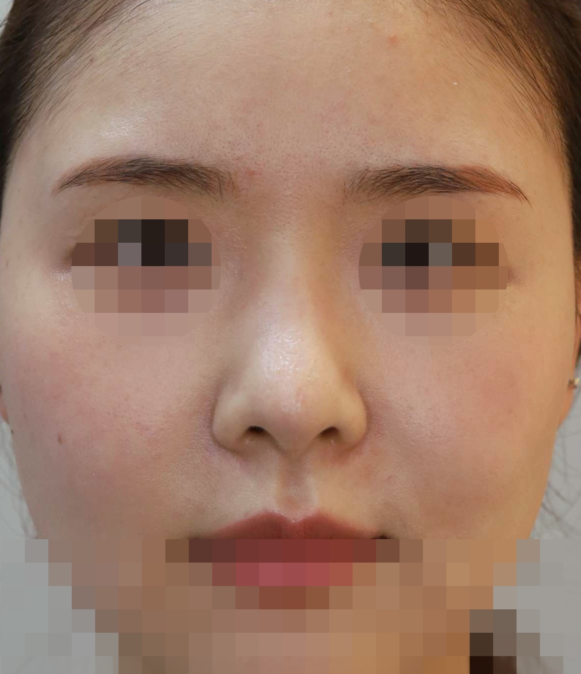 코젤코 제거, 코끝 복원 7개월 수술후