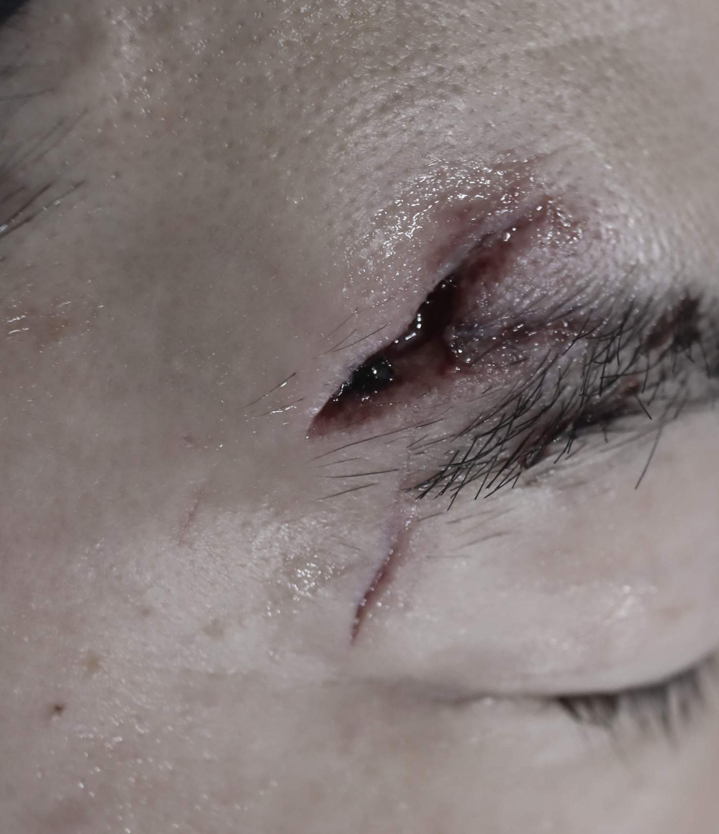 열상봉합, 흉터관리패키지 수술전