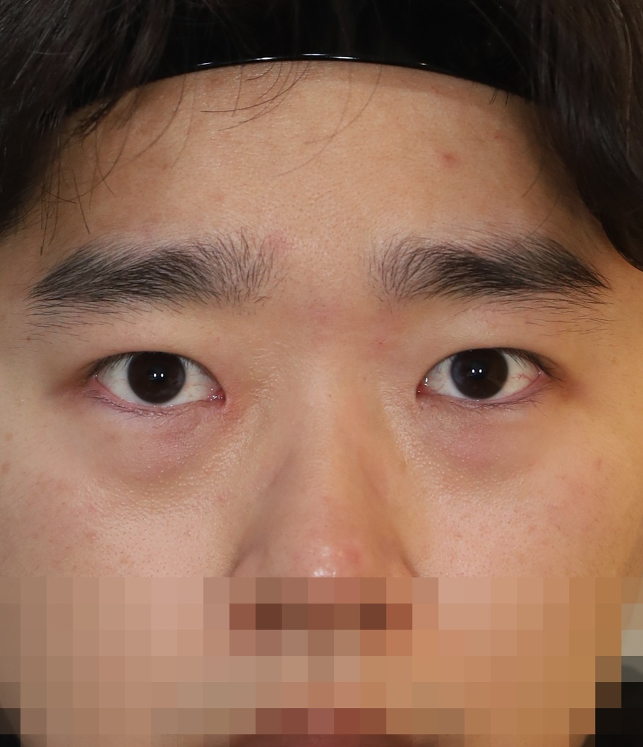 비절개 쌍꺼풀, 위트임 수술후