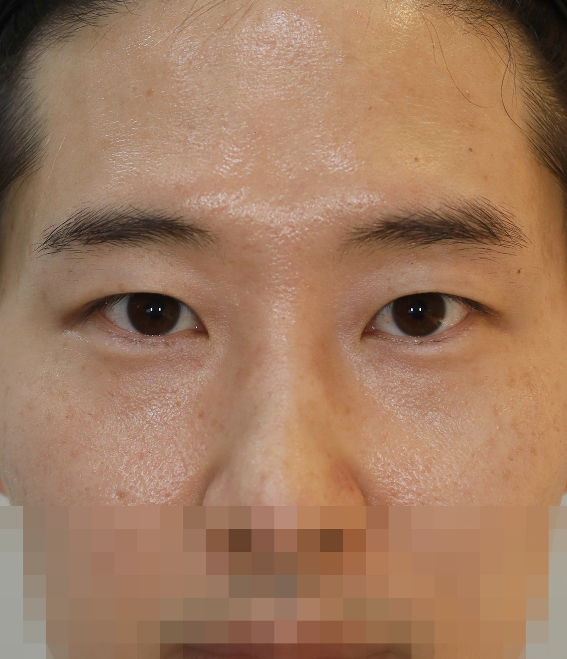 비절개 쌍꺼풀 3개월 수술후