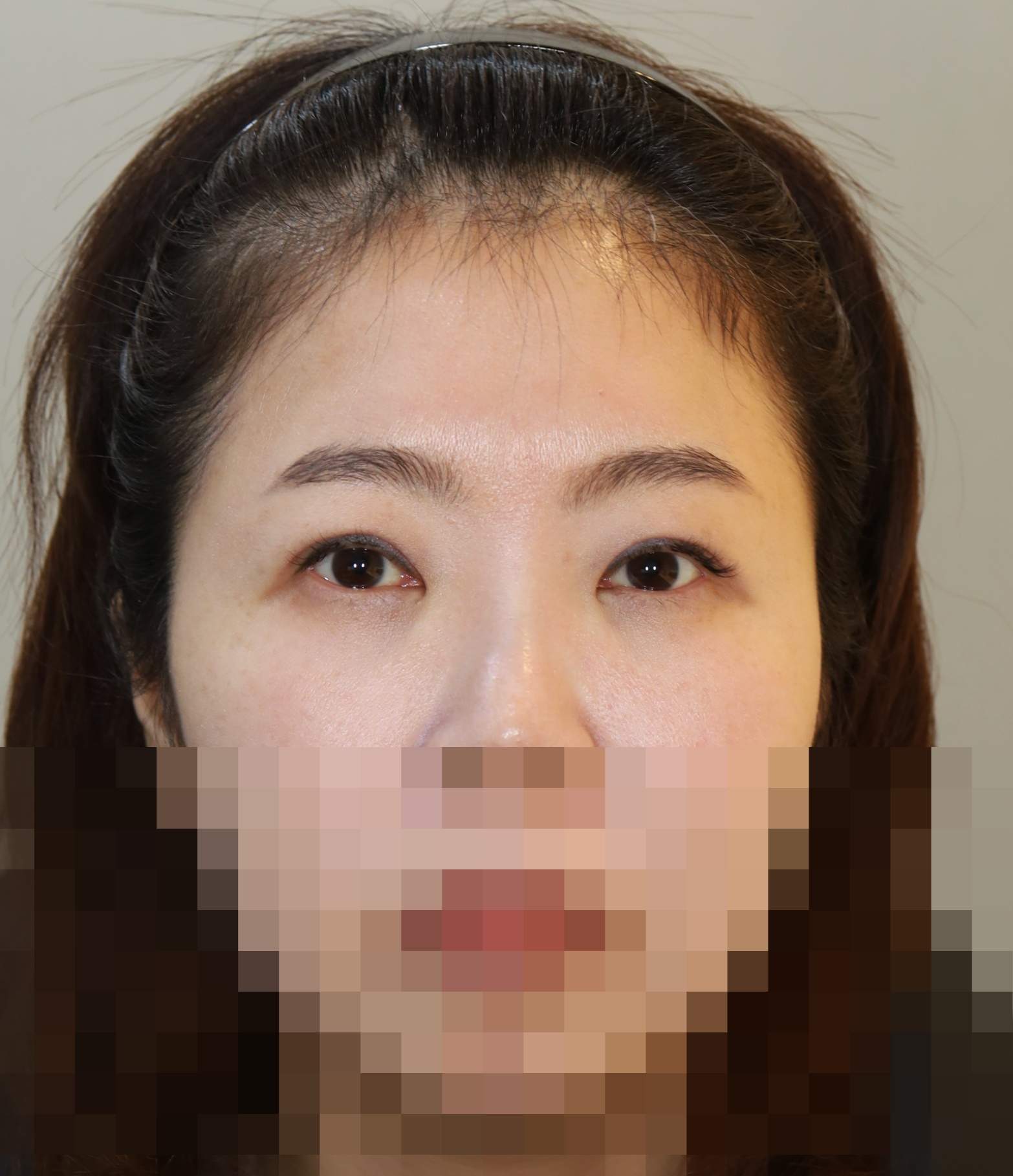 이마거상, 쌍꺼풀 라인 낮추기 재수술; 두줄따기 수술후