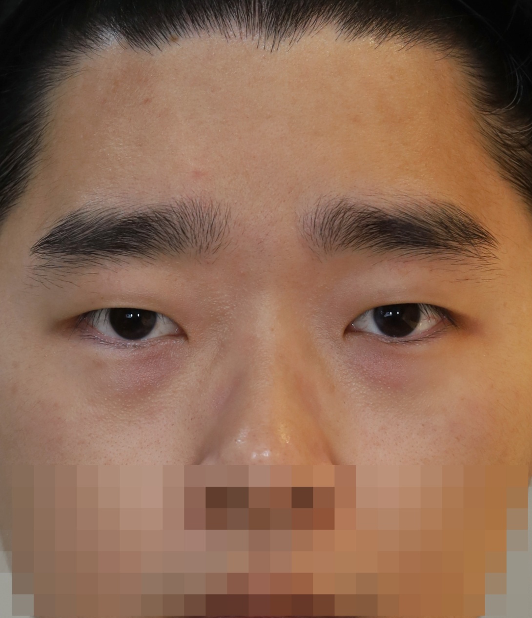 비절개 쌍꺼풀, 위트임 수술전