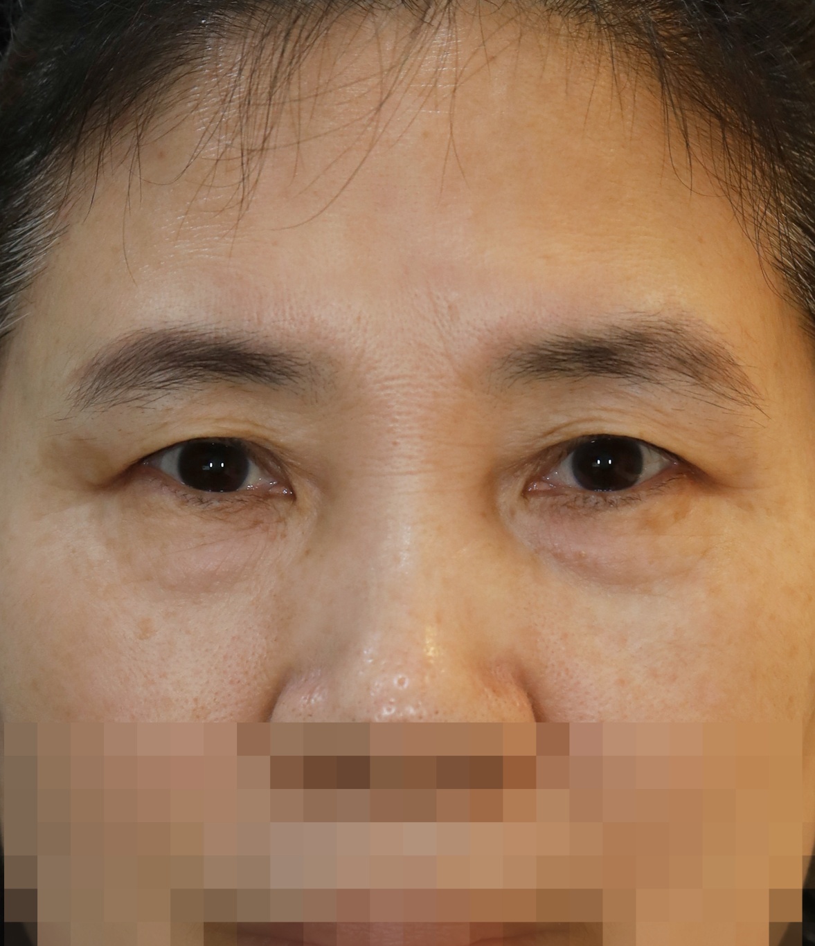 눈썹 밑 거상, 하안검 6개월 수술전