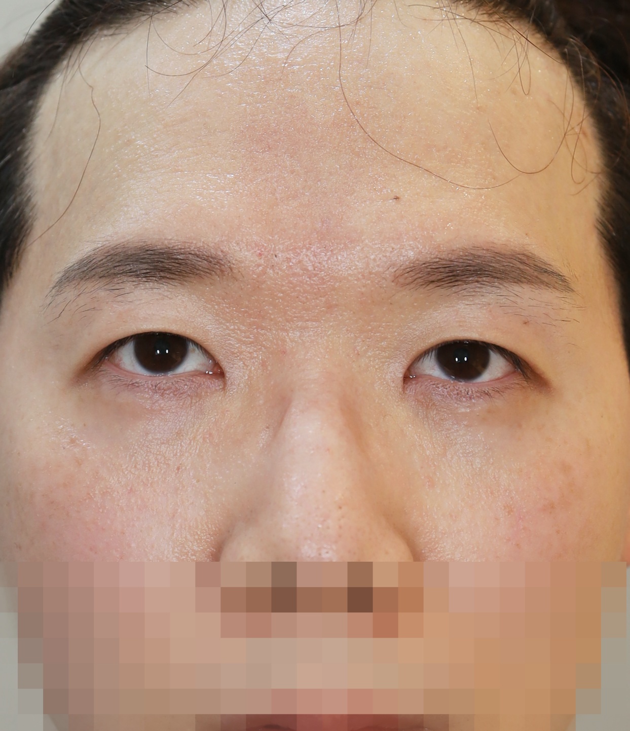 비절개 쌍꺼풀, 위트임 3개월 수술후