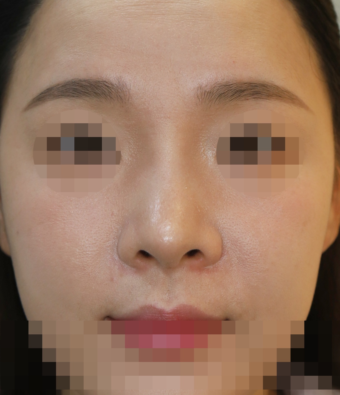 에버코 제거, 무보형물 코성형; 용코 교정 2개월 수술후