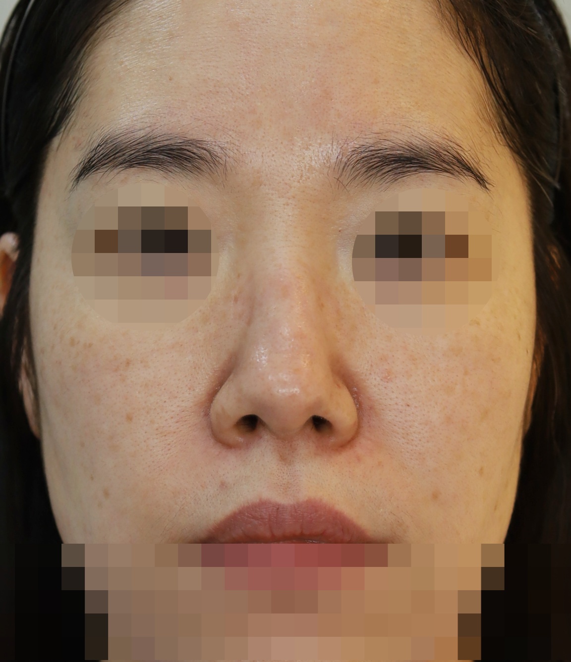 연골입자 제거, 코끝 복원 3개월 수술전