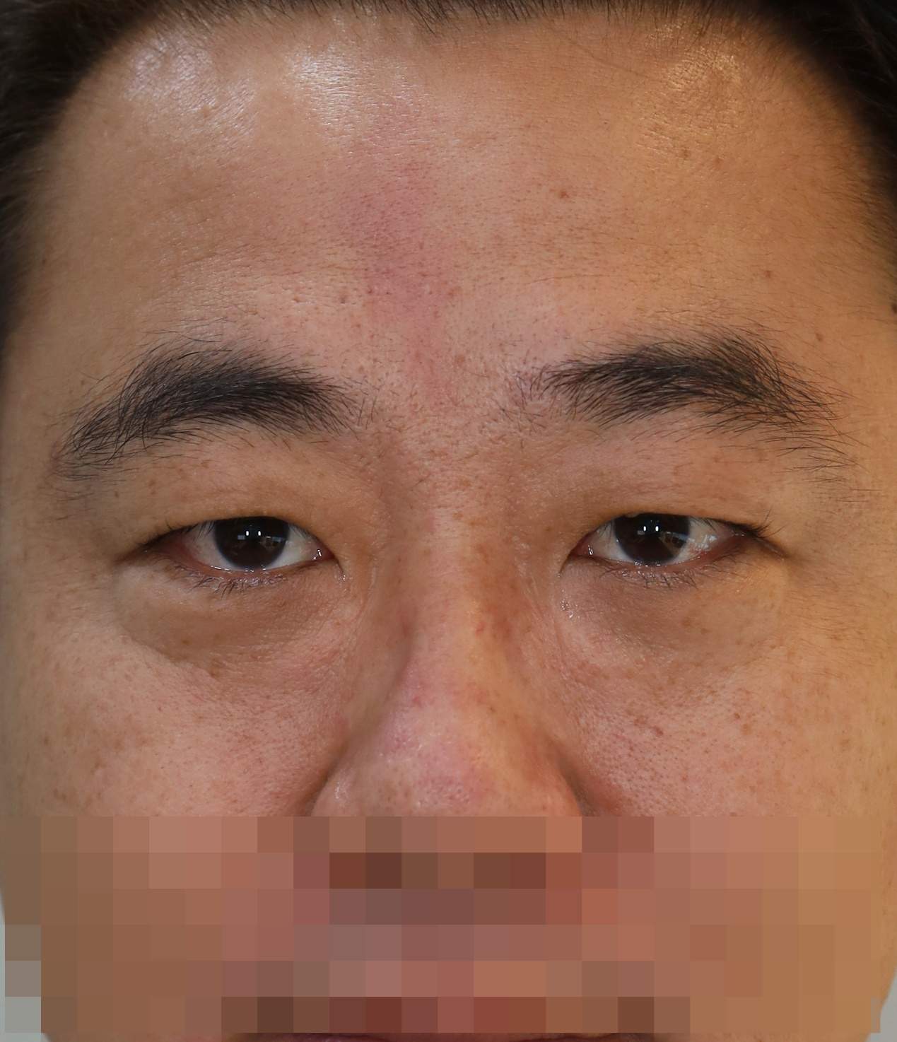 비절개 쌍꺼풀, 눈밑 지방 재배치 수술전