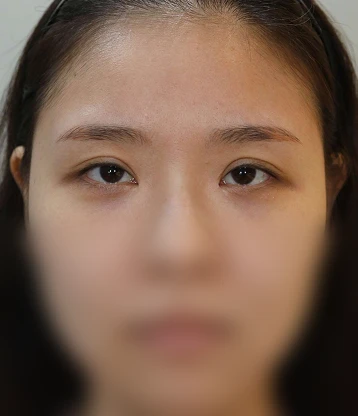 before 사진