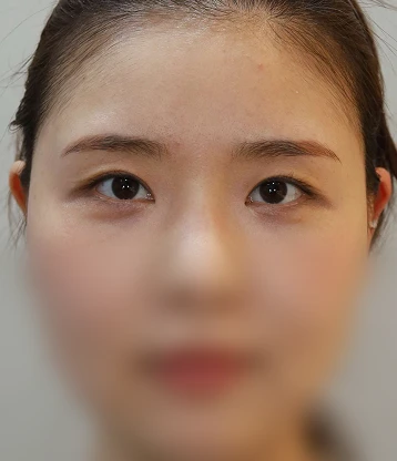 after 사진
