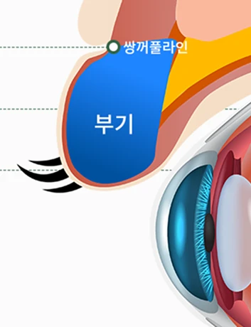 쌍커풀 before 사진