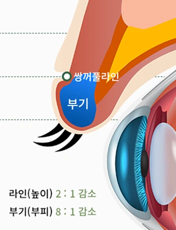쌍커풀 after 사진