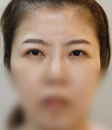 before 사진
