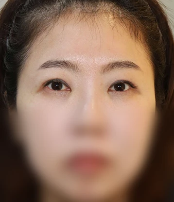 after 사진