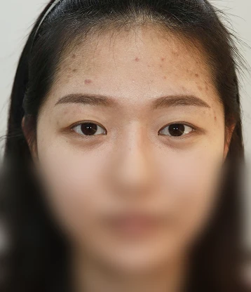 before 사진