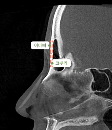 before 사진